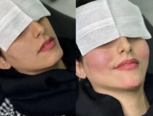 تخفیف ویژه ژل و بوتاکس به مناسبت روز شیراز واقع خیابان صاحب الامری