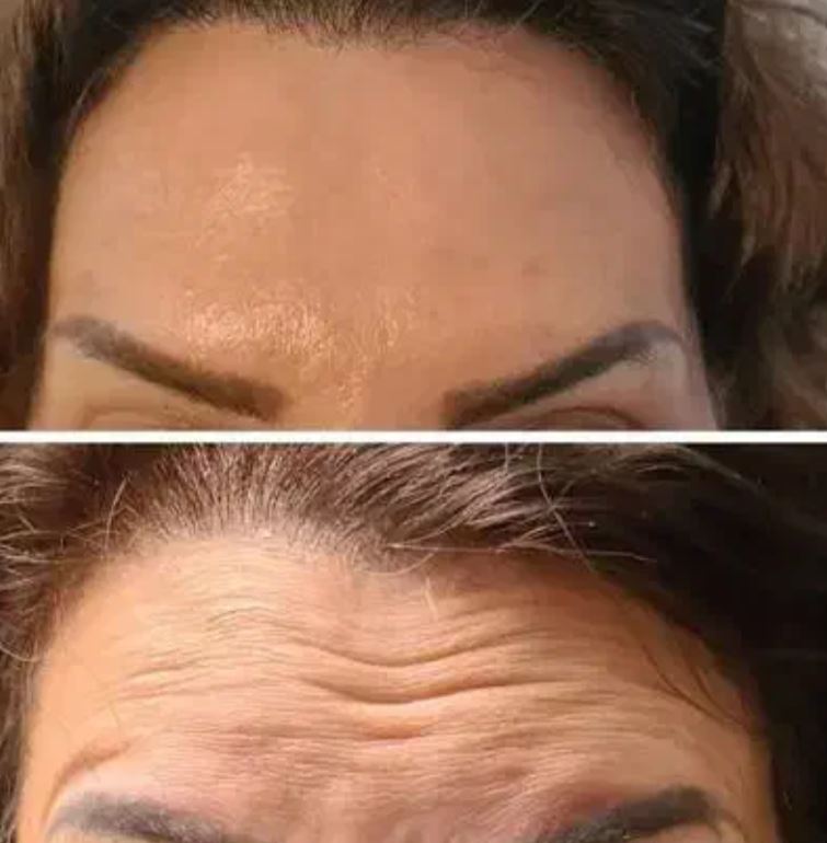 تزریق ژل و بوتاکس زیر نظر پزشک پوست و مو در میرزا کوچک خان شیراز - چروک