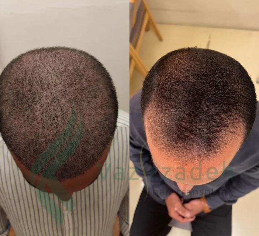 جشنواره کاشتمو با تخفیف ویژه در کازرون - درمانی