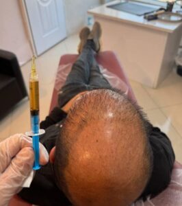 پی ار پی PRP و مزوتراپی مو،صورت، ابرو دست و ریش در قصرالدشت شیراز - اقایان