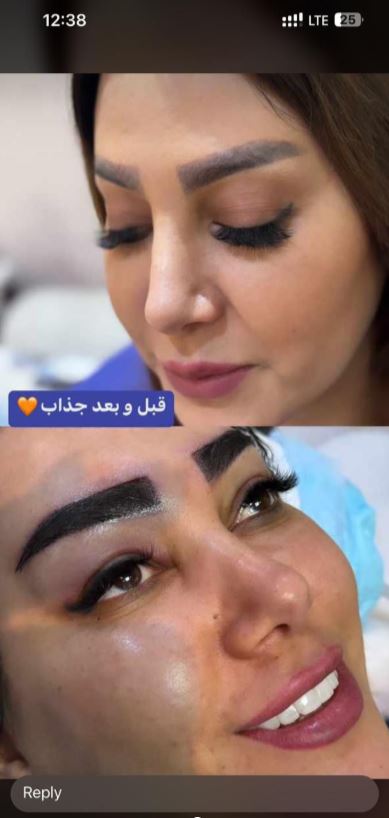 کاشت مو ، ابرو و ریش در شیراز - بهترین کیفیت